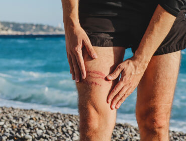 A jellyfish sting burn on a man's leg, on the beach By Andrei Antipov