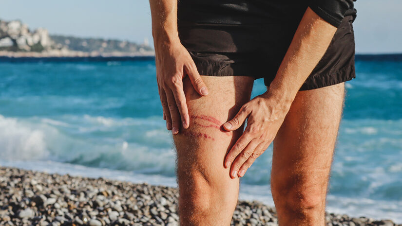 A jellyfish sting burn on a man's leg, on the beach By Andrei Antipov