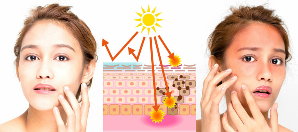 How to Relieve Sunburn - Scuba.com
